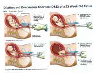 abortion1.jpg