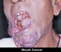 332_mouth_cancer2.jpg