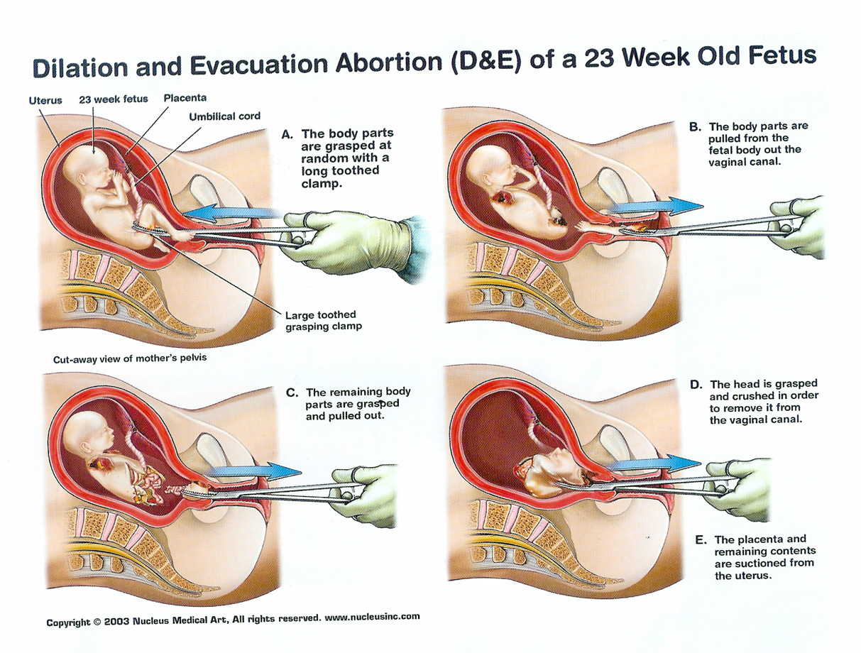 abortion1.jpg